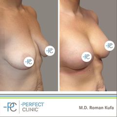 Zvětšení prsou - MUDr. Roman Kufa