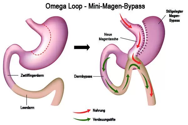 magenbypass OP