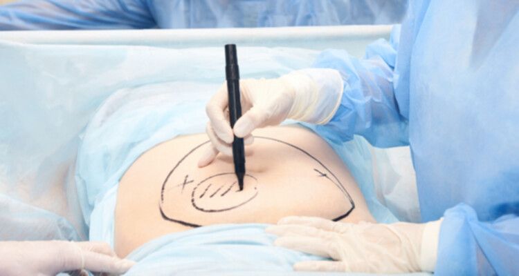 Fettabsaugung (Liposuktion)