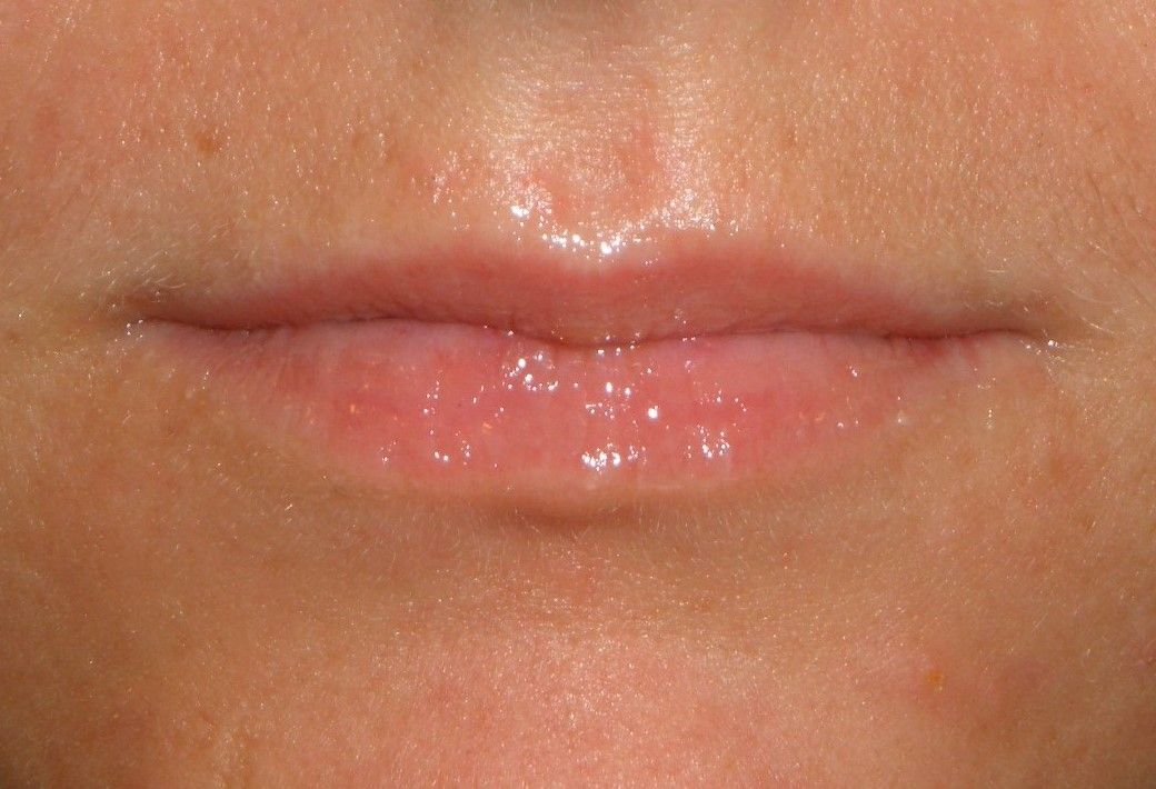 Vor der Lippenunterspritzung mmit MaiLi - Foto: Dr. Juri Huber-Vorländer