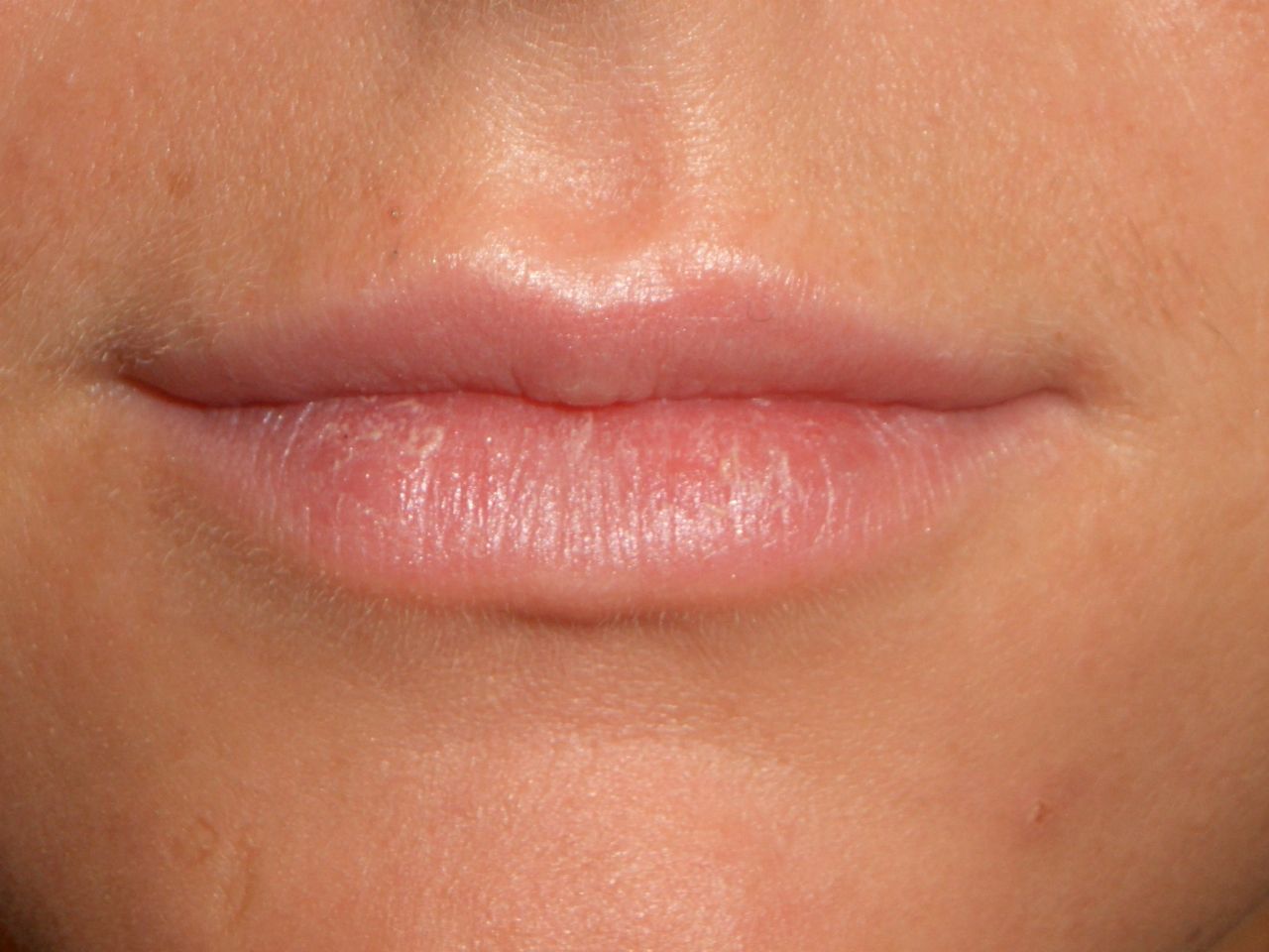 Nach der Lippenunterspritzung mit MaiLi - Foto: Dr. Juri Huber-Vorländer