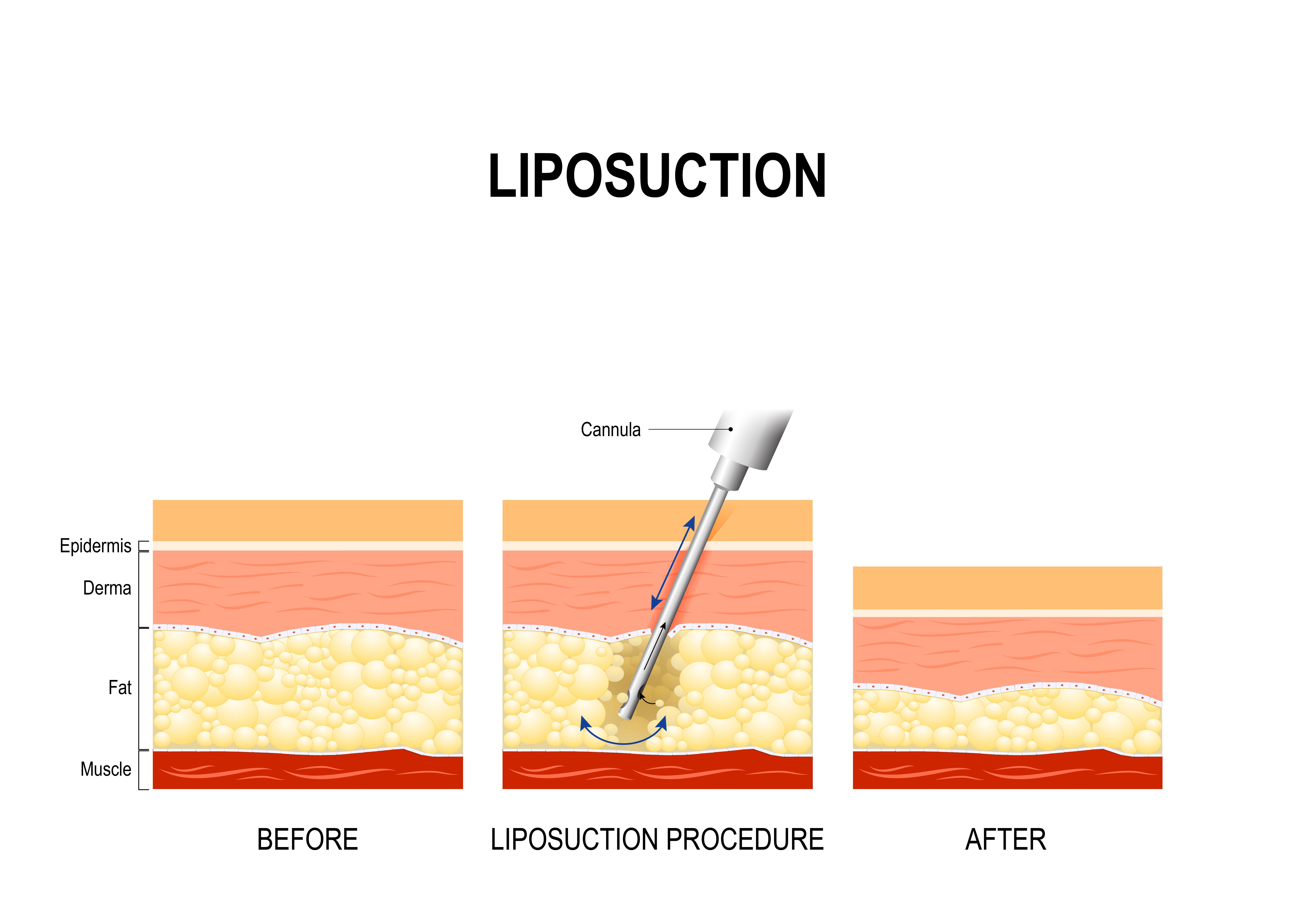 Verfahren der Liposuktion