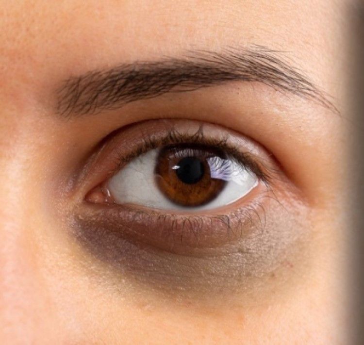 Die Eigenfettunterspritzung eignet sich als sehr effktive Methode gegen Augenringe