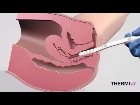vaginal canal