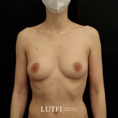 Brust Eigenfett 0019.jpg