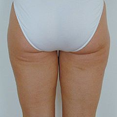 Klassische Liposuktion