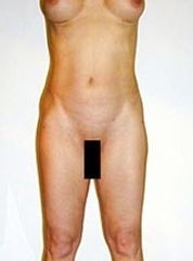 liposukce1před