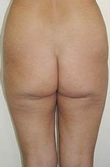 liposukce3před