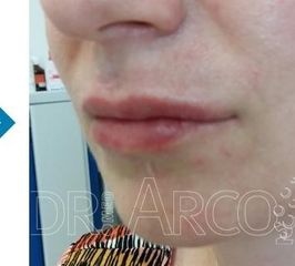 arco vorher nachher lippen2