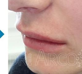 arco vorher nachher lippen4