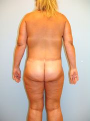 bodylift2před