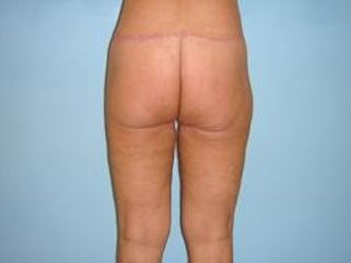 bodylift3před