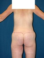 bodylift4před