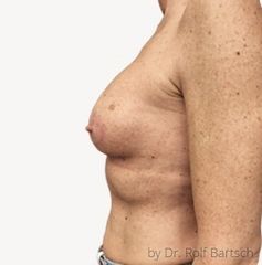 Bruststraffung mit Implantat