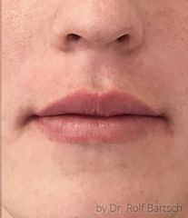 Lippenvergrößerung