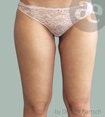 Liposuktion