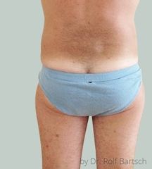 Lipo Flanken