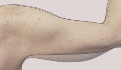 Lipo Arm