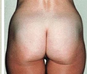 cellulite