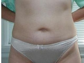 liposonix2