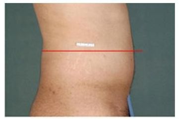 liposonix 1