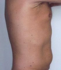 liposonix 3