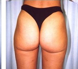 liposukce 1