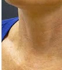 PRP (Platelet Rich Plasma)