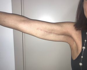 Dott. Luca Maione Liposcultura