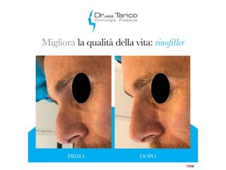 Rinofiller prima e dopo