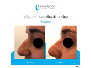 Rinofiller prima e dopo
