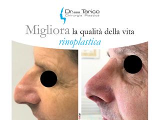 Rinoplastica prima e dopo