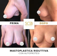 SCEB Salute Chirurgia Estetica Benessere Mastoplastica riduttiva