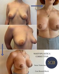 SCEB Salute Chirurgia Estetica Benessere Mastoplastica correttiva