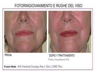 Ringiovanimento viso