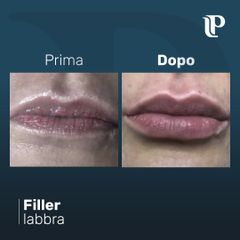 Filler labbra - Dott Luigi Petti