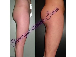 Gluteoplastica Dott. Scimè