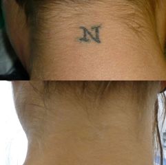 rimozione tatuaggio