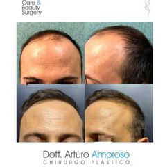 Trapianto capelli - Dott. Arturo Amoroso
