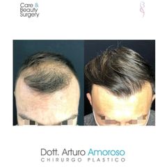 Trapianto capelli - Dott. Arturo Amoroso