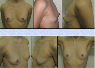 Mastoplastica additiva sottomuscolare dual plane protesi anatomiche  PRE INTERVENTO