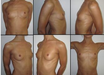 Mastoplastica additiva sottomuscolare dual plane protesi anatomiche accesso SOLCO