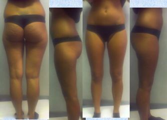 Lipoaspirazione ultrasonica ual fianchi-trocanteri-interno coscia-ginocchio