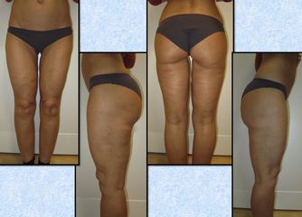 Lipoaspirazione ultrasonica post operatorio