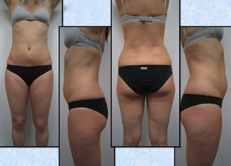 Lipoaspirazione ultrasonica pre