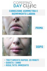 Filler labbra - Chirurgia Estetica Nestola - Dott. Luigi Nestola