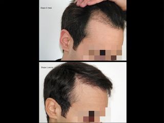 Trapianto capelli prima e dopo