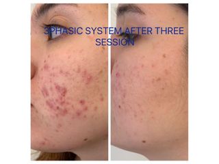 Acne - LaCLINIQUE of Switzerland®