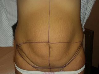 pre addominoplastica completa
