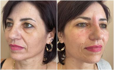 Filler - Cliniche Novagenesis - dott. Alberto Rossi Todde
